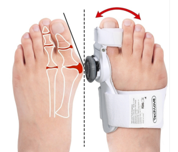 Hallux Valgus: Tratament eficient pentru corectarea problemei