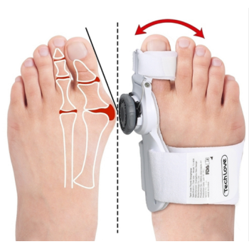 Hallux Valgus: Tratament eficient pentru corectarea problemei