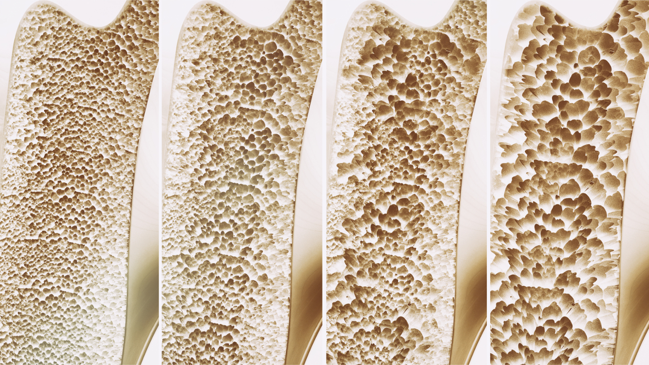 Ce este osteoporoza: simptome, factori de risc și metode de prevenire - Ortek